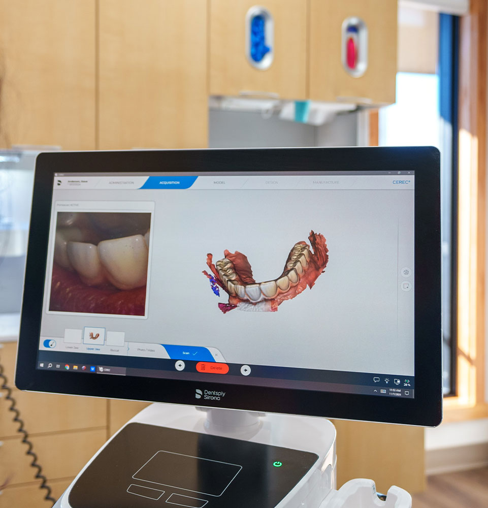 cerec machine crowns
