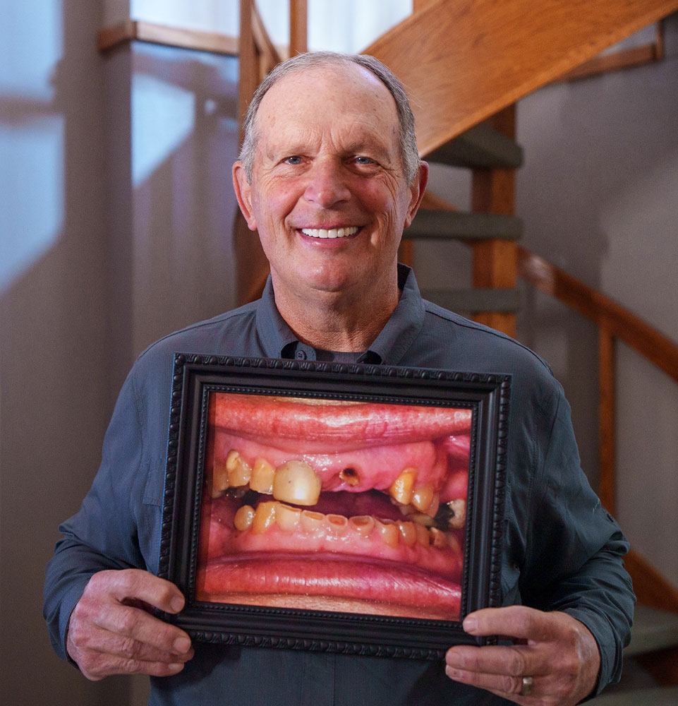 dental implant before after calkins