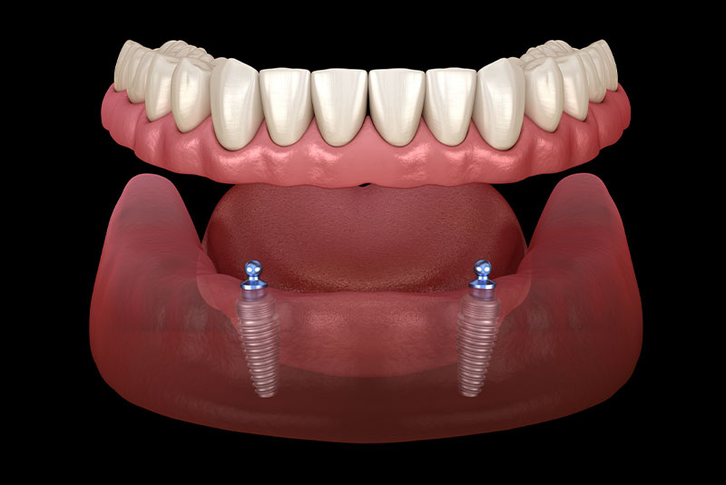 snap on dentures