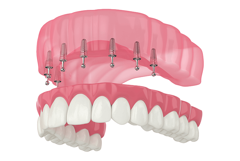 dentures
