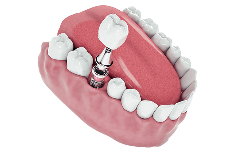 dental implant