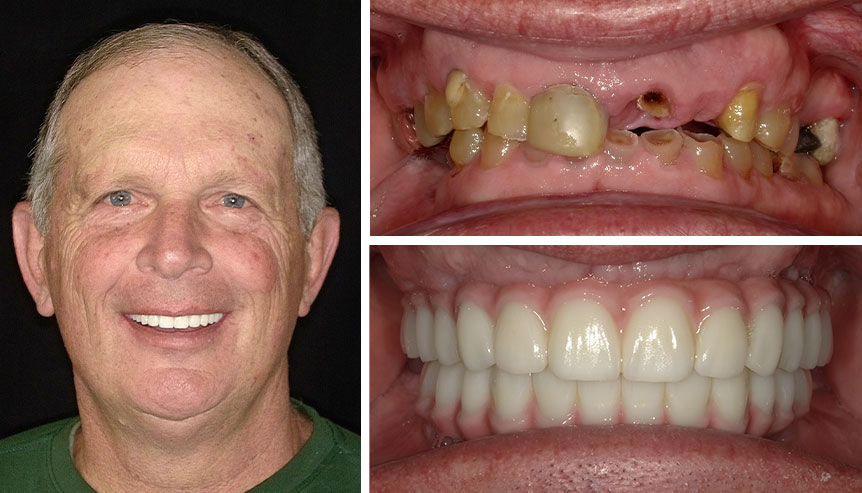 brandt before after