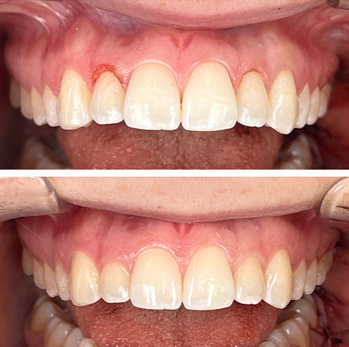 gingivectomy before after