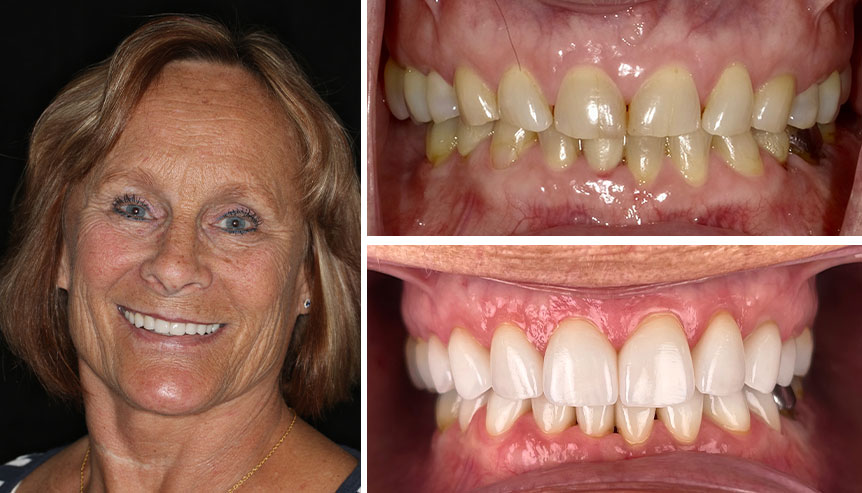 joy before after full mouth