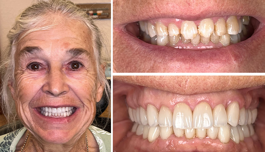 patient h before after full mouth