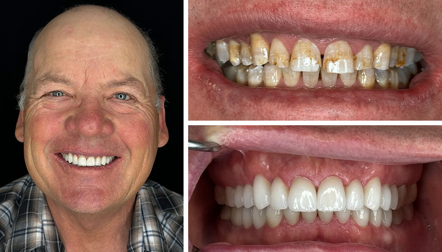 patient x before after full mouth