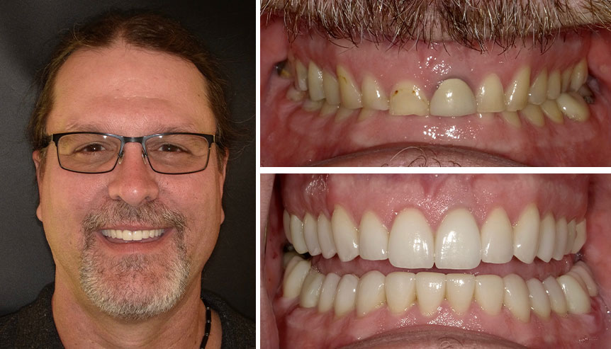 shawn before after
