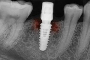 An x-ray of a dental implant with signs of inflammation and bone loss around the implant. No text on image.