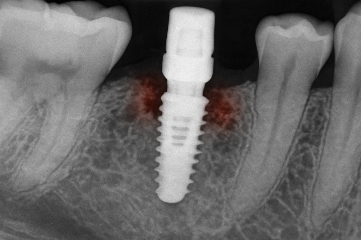 An x-ray of a dental implant with signs of inflammation and bone loss around the implant. No text on image.